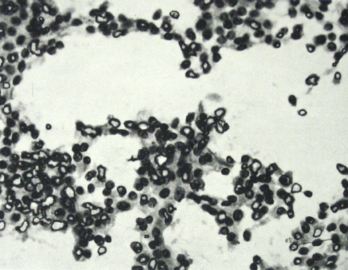 Cancer Cells Part 2